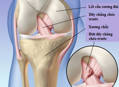 Tập vật lý trị liệu sau phẩu thuật đứt dây chằng chéo trước