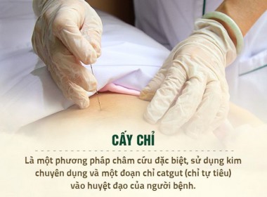 Cấy chỉ - Phương pháp điều trị mang về hiệu quả tối ưu