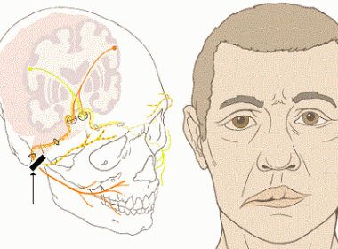 Liệt dây thần kinh số 7