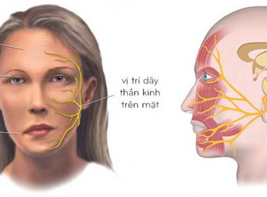 Liệt dây thần kinh số VII, liệt Bell