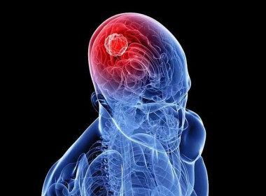 Méo miệng, khó nhắm mắt - dấu hiệu liệt dây thần kinh số VII