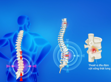 Thoát vị đĩa đệm cột sống thắt lưng