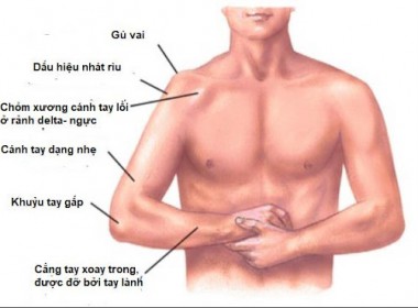 Trật khớp vai