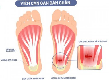 Viêm gân gan bàn chân